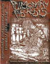 Pulmonary Fibrosis: Severe Pulmonic Valve Regurgitation cassette