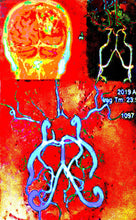 Schistosomiasis: Excretion Of Sporocysts In Parasitic Worm Vomitus cassette