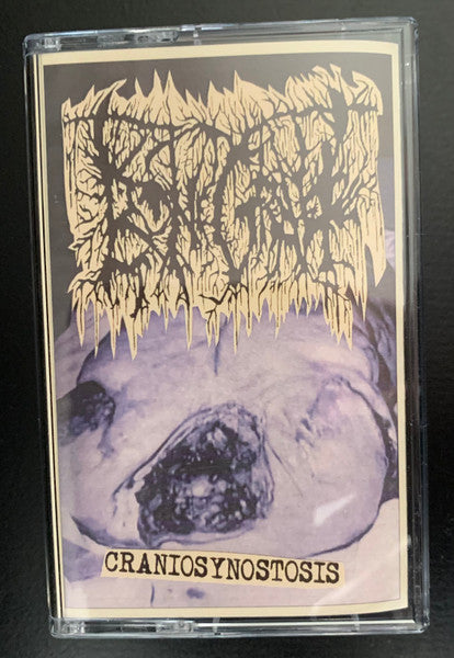 Bonegraft: Craniosynostosis cassette