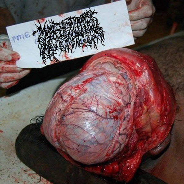 Malignant Hyperthermia: Cutaneous Blastomycosis CD