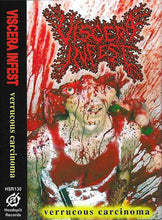 Viscera Infest: Verrucous Carcinoma cassette